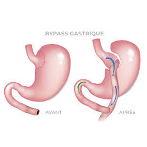 Bypass gastrique Tunisie