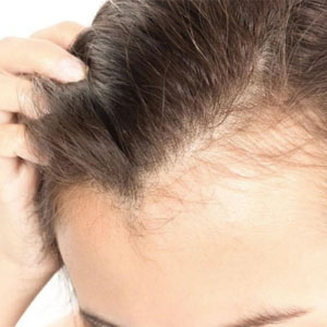 greffe de cheveux tunisie
