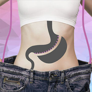 sleeve gastrectomie tunisie