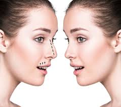 Rhinoplastie médicale