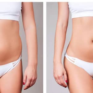 liposuccion ventre