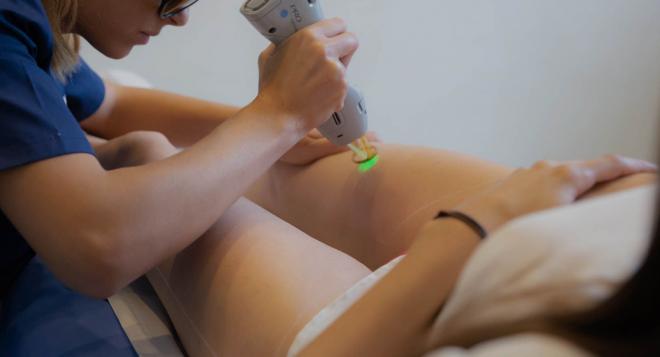 Un traitement au laser durant la grossesse